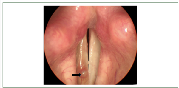 성대에 있는 낭종(검은화살표) Parasites, Hosts and Diseases 2023;61(3):298-303 캡처
